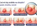 Ilustracje pokazują różne zmiany na dziąśle: guzek, krostkę, ropień i ranę. Zobacz, co może oznaczać dziura w dziąśle.