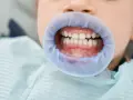 Uśmiechnięte siekacze u dziecka, gotowe na wizytę u dentysty.