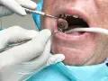 Dentysta używa narzędzi, by delikatnie wyciągnąć ropę z zęba pacjenta, podczas gdy ssak odsysa płyny.