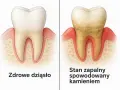 Porównanie zdrowego zęba i dziąsła z zębem objętym stanem zapalnym spowodowanym kamieniem. Dowiedz się, jak usunąć kamień nazębny.