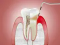 Przekrój zęba z widocznymi naczyniami krwionośnymi i nerwami. Narzędzie dentystyczne bada obszar, gdzie może pojawić się drętwienie dziąseł.