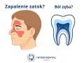 Ból podniebienia przy zębach górnych może być objawem zapalenia zatok lub problemów z zębami. Ilustracja porównuje zatoki i przekrój zęba.