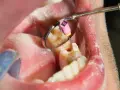Zabieg stomatologiczny: martwy ząb jedynka w trakcie leczenia kanałowego. Widoczny instrument i lusterko dentystyczne.