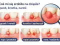 Krwiak na dziąśle: guzek, krostka, pęcherzyk, przetoka, rana. Ilustracje pokazują różne zmiany na dziąsłach.