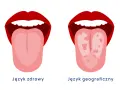 Dwa języki: zdrowy, różowy i gładki, oraz język geograficzny z plamami.