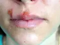 Spuchnięte usta u dziecka z pęcherzykami i strupkami.