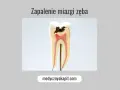 Przekrój zęba z widocznym zapaleniem miazgi. Widoczna próchnica sięgająca do miazgi jedynki.
