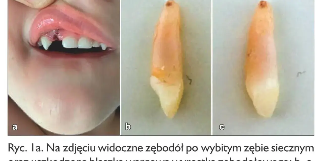 Dziecko z uszkodzonym zębodołem po wybitym zębie mlecznym. Widoczny ruszający się ząb mleczny po uderzeniu.