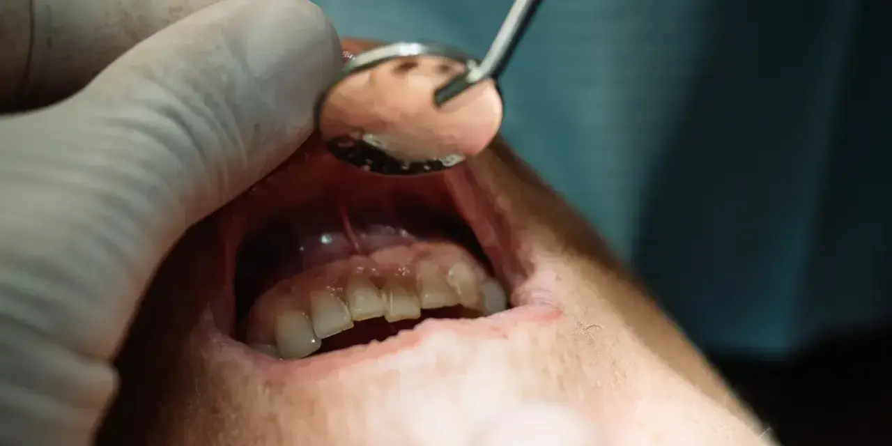 Dentysta bada ropień na dziąśle pacjenta za pomocą lusterka.