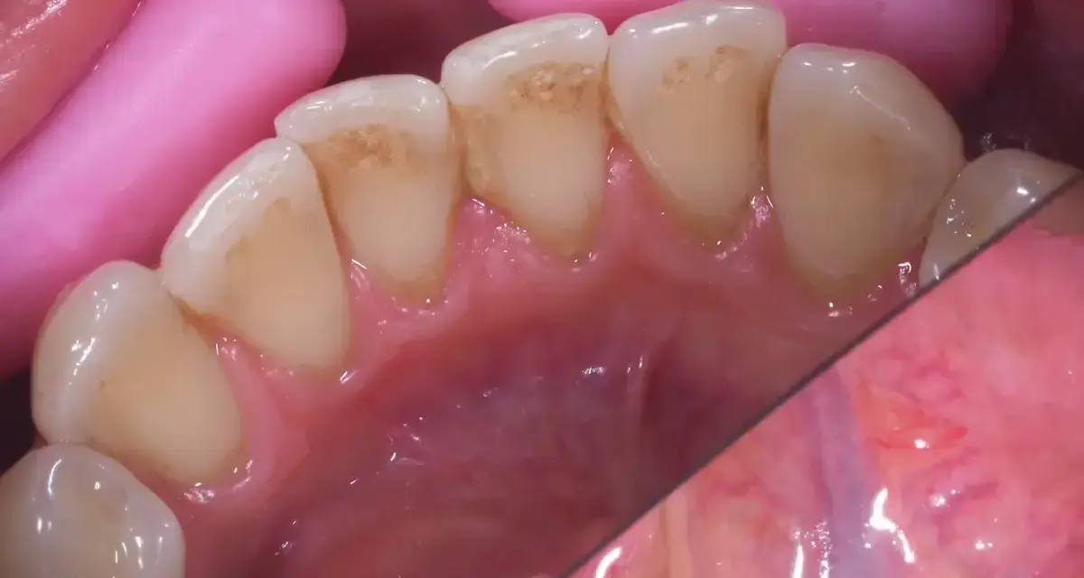 Widoczne przebarwienia na zębach i zaczerwienione, lekko opuchnięte dziąsło przy zębie.
