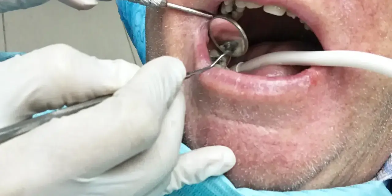 Dentysta używa narzędzi, by delikatnie wyciągnąć ropę z zęba pacjenta, podczas gdy ssak odsysa płyny.