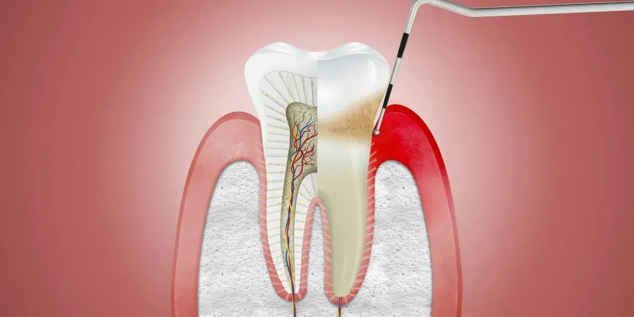 Przekrój zęba z widocznymi naczyniami krwionośnymi i nerwami. Narzędzie dentystyczne bada obszar, gdzie może pojawić się drętwienie dziąseł.