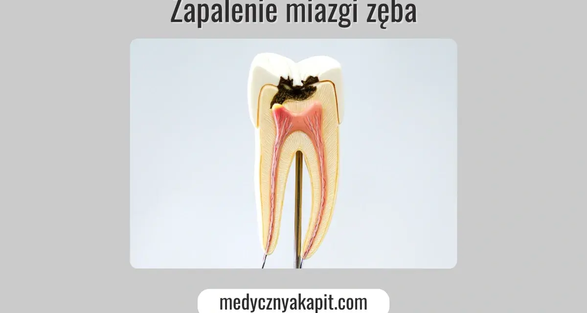 Przekrój zęba z widocznym zapaleniem miazgi. Widoczna próchnica sięgająca do miazgi jedynki.