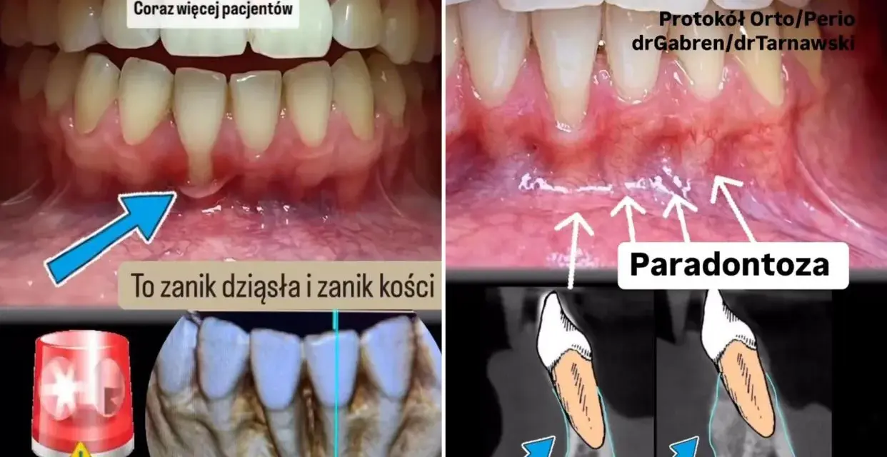 Widoczne odsłonięte szyjki zębowe, zanik dziąseł i kości. Paradontoza prowadzi do utraty zębów.