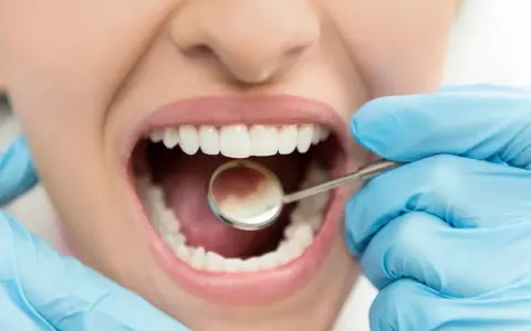 Uśmiechnięta pacjentka z idealnymi zębami podczas badania stomatologicznego. Stomatolog w rękawiczkach używa lusterka do kontroli jamy ustnej, dbając o zdrowie zębów.
