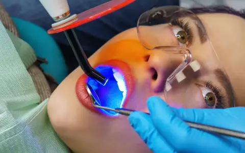 Zabieg malowania zębów światłem UV. Dentysta utwardza materiał, by uzyskać piękny uśmiech.