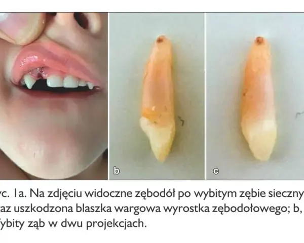 Dziecko z uszkodzonym zębodołem po wybitym zębie mlecznym. Widoczny ruszający się ząb mleczny po uderzeniu.