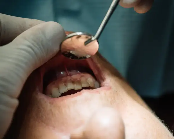 Dentysta bada ropień na dziąśle pacjenta za pomocą lusterka.