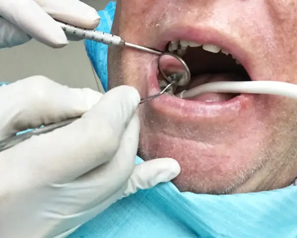 Dentysta używa narzędzi, by delikatnie wyciągnąć ropę z zęba pacjenta, podczas gdy ssak odsysa płyny.