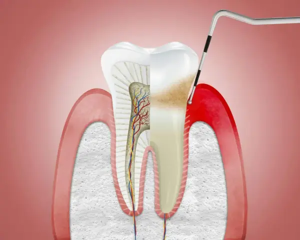 Przekrój zęba z widocznymi naczyniami krwionośnymi i nerwami. Narzędzie dentystyczne bada obszar, gdzie może pojawić się drętwienie dziąseł.