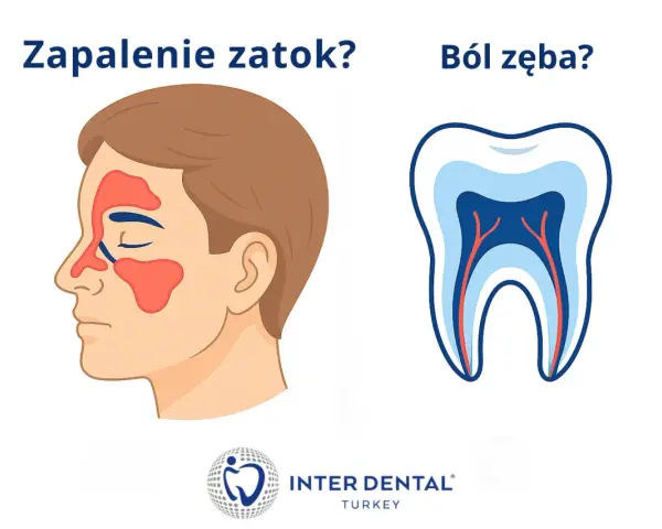 Ból podniebienia przy zębach górnych może być objawem zapalenia zatok lub problemów z zębami. Ilustracja porównuje zatoki i przekrój zęba.