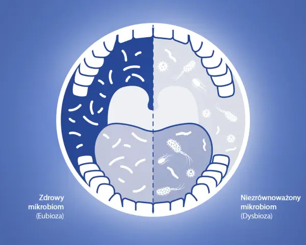 Porównanie zdrowego i niezrównoważonego mikrobiomu jamy ustnej. Chlorheksydyna co to? Pomaga przywrócić równowagę.