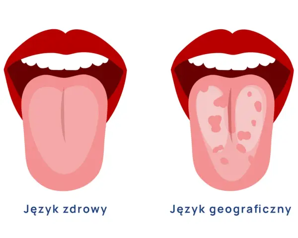 Dwa języki: zdrowy, różowy i gładki, oraz język geograficzny z plamami.