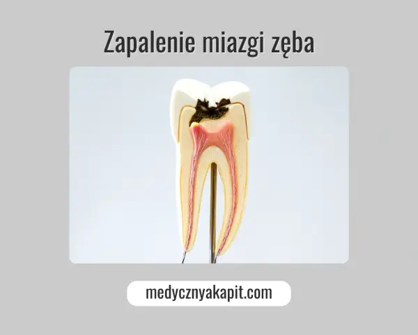 Przekrój zęba z widocznym zapaleniem miazgi. Widoczna próchnica sięgająca do miazgi jedynki.