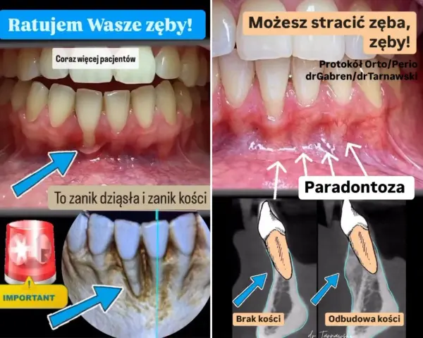Widoczne odsłonięte szyjki zębowe, zanik dziąseł i kości. Paradontoza prowadzi do utraty zębów.