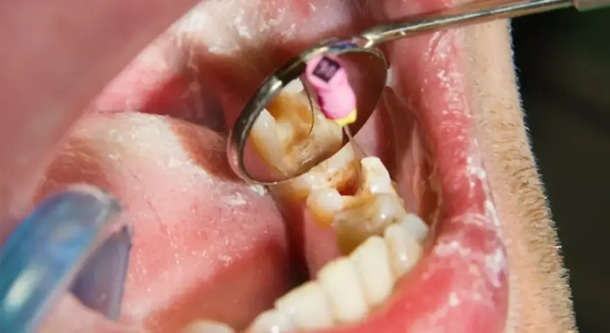 Zabieg stomatologiczny: martwy ząb jedynka w trakcie leczenia kanałowego. Widoczny instrument i lusterko dentystyczne.