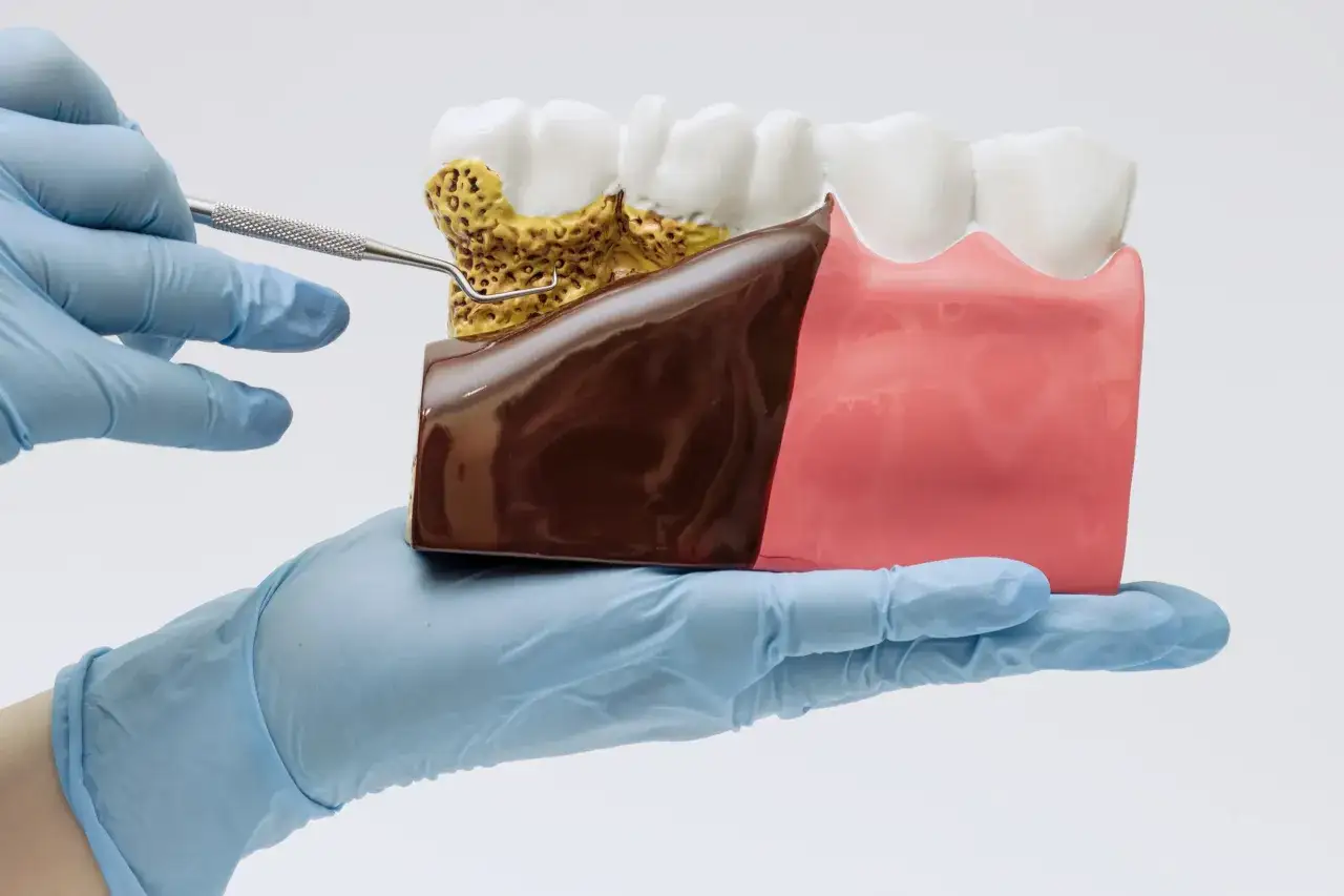 Model szczęki z widocznym kamieniem nazębnym i objawami infekcji dziąsła. Rękawiczka z narzędziem dentystycznym.