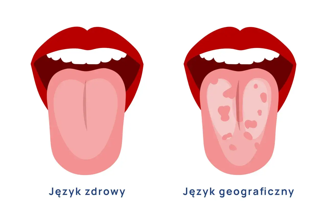 Dwa języki: zdrowy, różowy i język geograficzny z czerwonymi plamami.