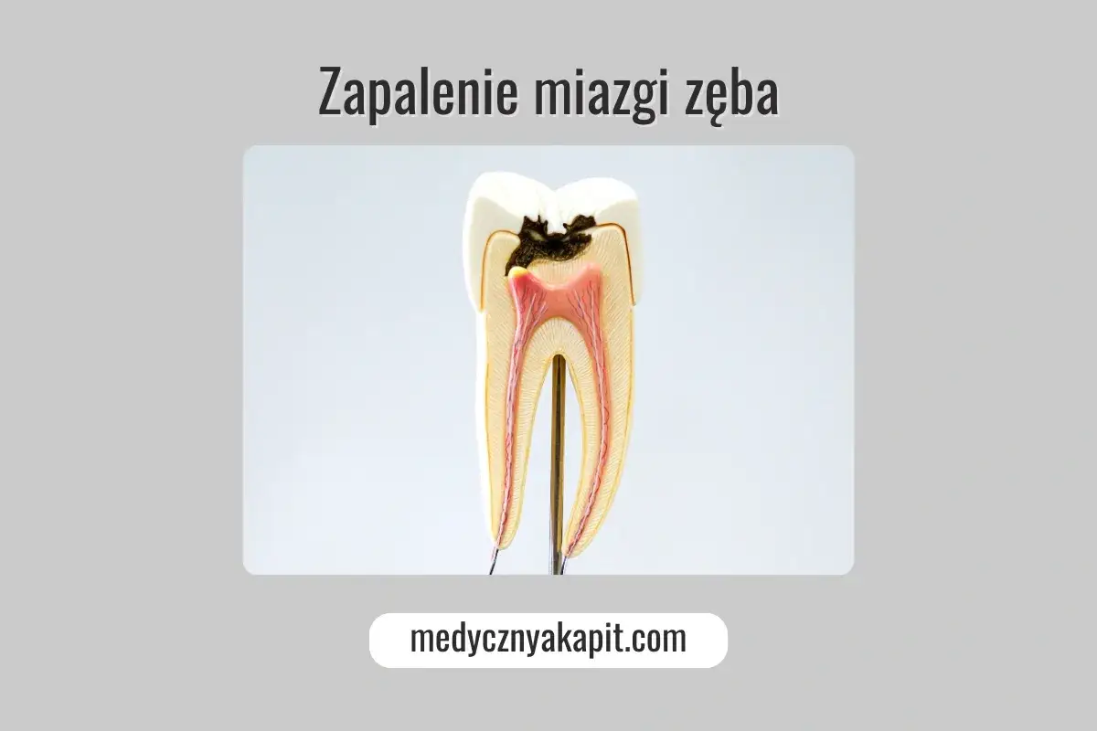 Przekrój zęba ukazujący próchnicę sięgającą miazgi, co prowadzi do nieleczonego stanu zapalnego zęba.